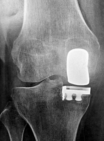 Arthrose interne isolé