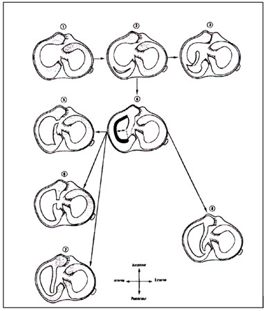 Lésions méniscales
