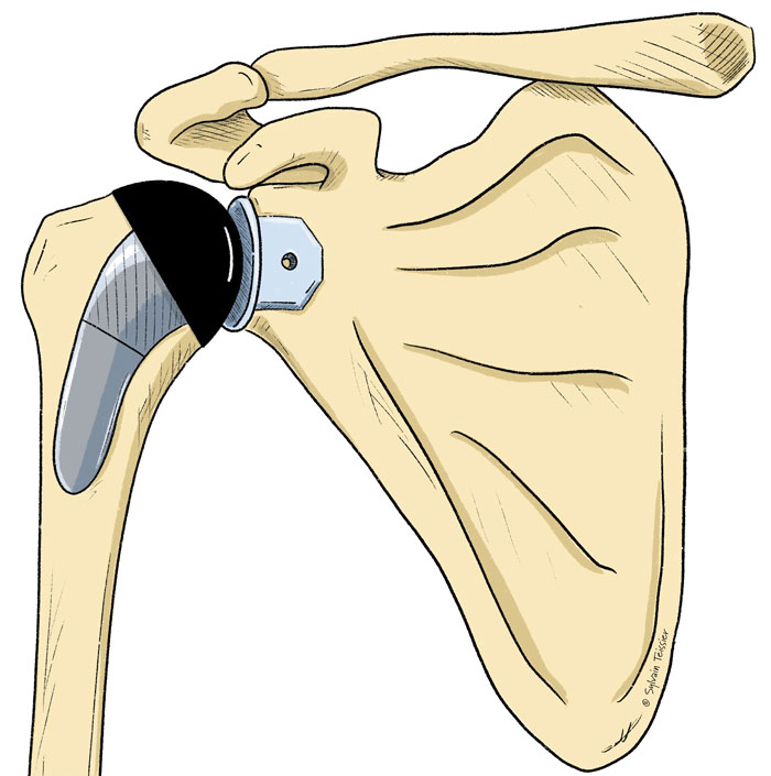 prothese epaule anatomique