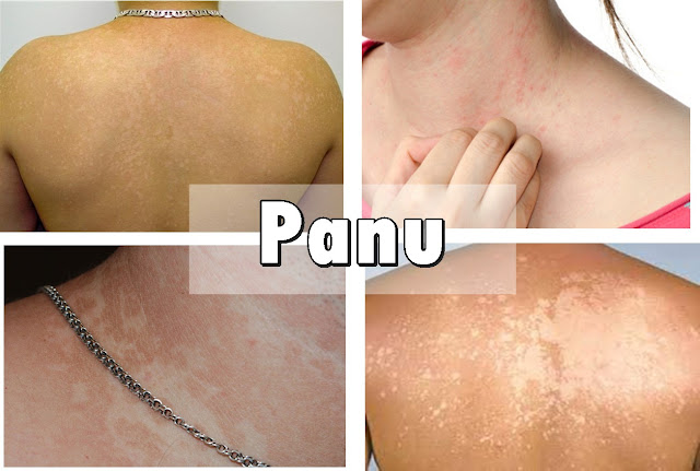 Simple Cara Menghilangkan Panu Secara Alami Dengan Cepat Dalam