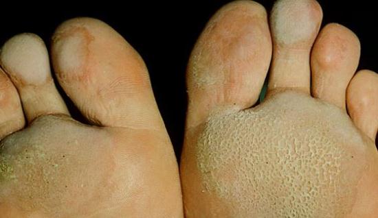 Kaki Berlubang Seperti Rumah Rayap Inilah Cara Ampuh Mengobati