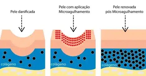 Microagulhamento em Fortaleza