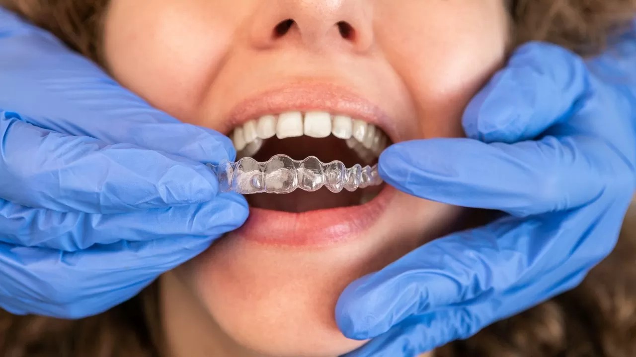 dentist in gloves applying invisible aligner on fe 2022 09 26 23 20 16 utc Large