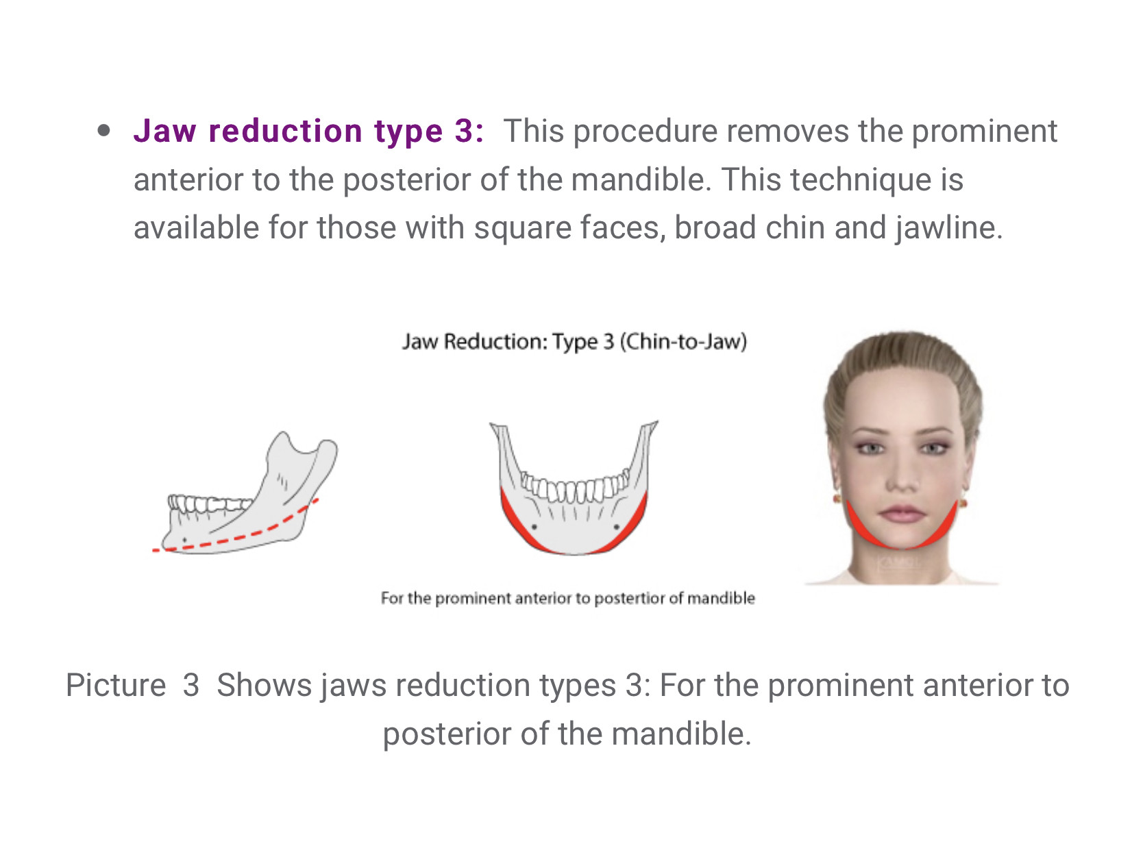 How to reduce the square jaw from the bone and remove the strong muscles around the jaw line. All Posts From Nctyleggo In Official Plastic Surgery Thread Onehallyu