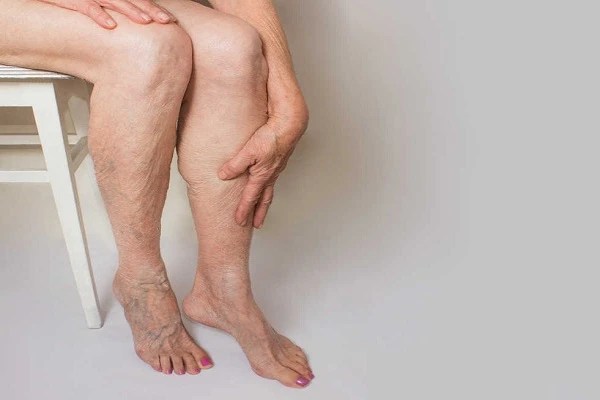 Sangat Mudah, Cara Menghilangkan Varises di Kaki Dengan Cepat