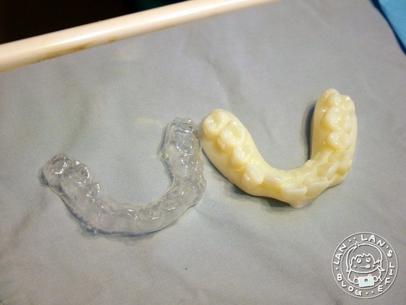 新竹牙套推薦牙套 Bdrbmi