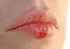 A cold sore is a small blister or group of blisters that usually develop on the lip or around the mouth. Cold Sores Linked To Dementia