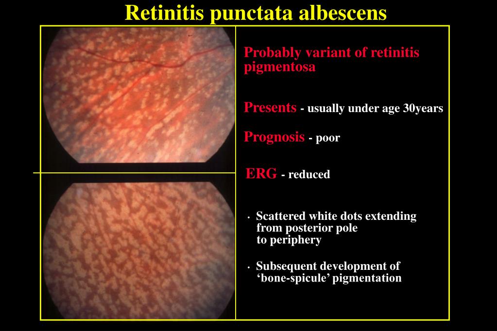 Learn about causes, diagnosis, treatment, and more. PPT - HEREDITARY RETINAL DYSTROPHIES PowerPoint