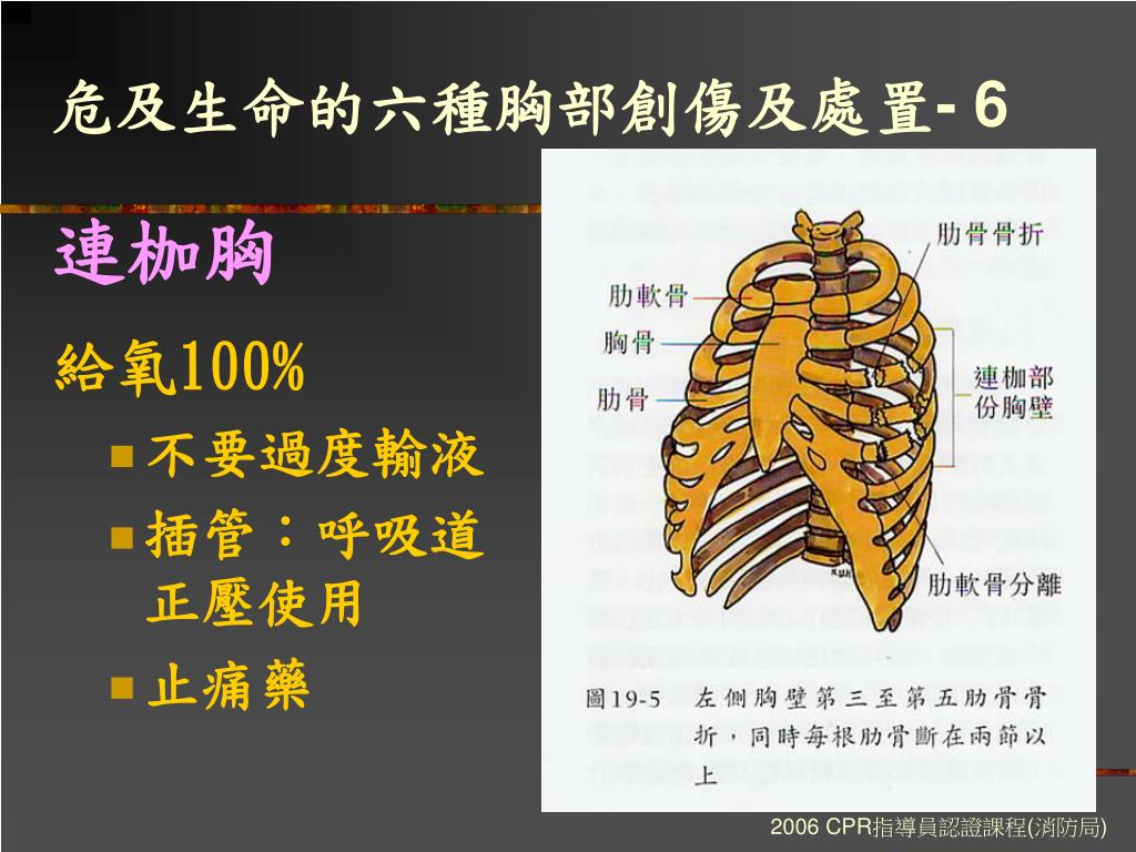 連枷胸一位連枷胸個案行鎖定式肋骨鋼板 Ivwccp