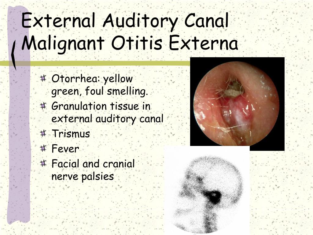 otitis externa is primarily a clinical diagnosis. Ppt Approach To Ear Problems Powerpoint Presentation Free Download Id 646883