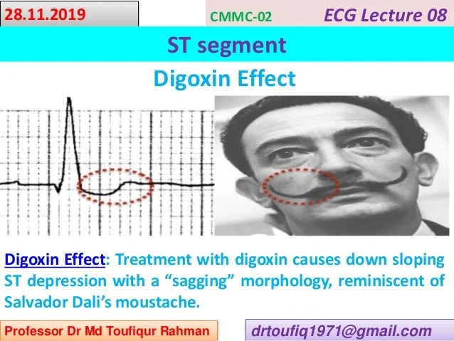 Ecg St Segment