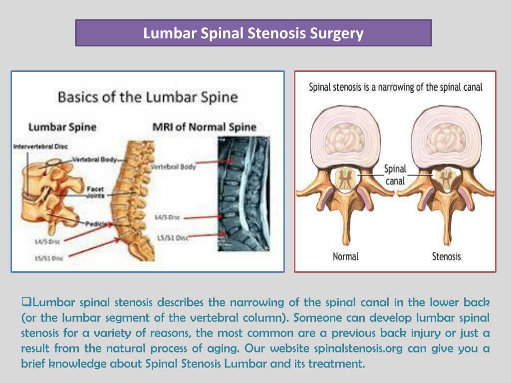 Lumbar stenosis surgery