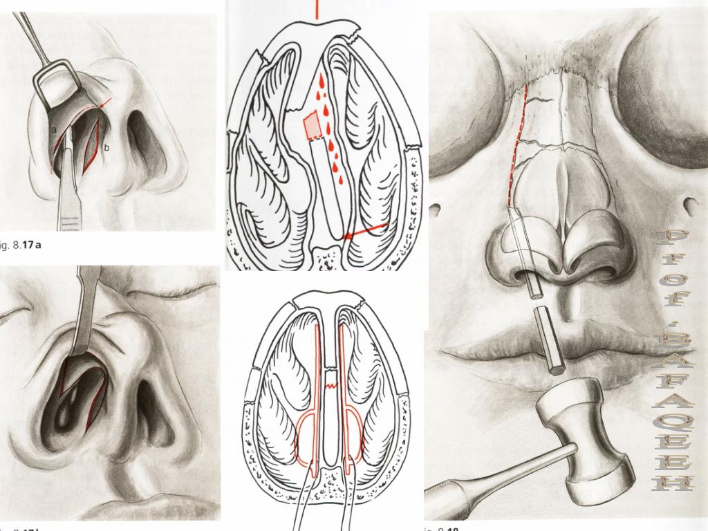 All our academic papers are written from scratch. PPT - NASAL FRACTURES PowerPoint Presentation, free