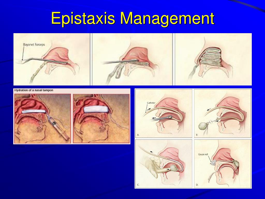 Such anaesthesia is obtained by injecting a small dose of hyperbaric local anaesthetic (la) in a patient maintained in sitting position for a few minutes to . PPT - Maxillofacial Injuries in Sports and Exercise