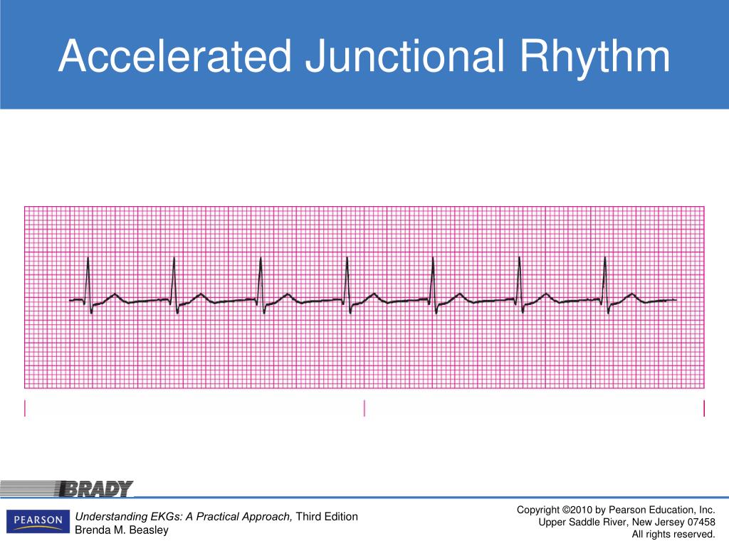 photo Junctional Rhythm Ecg Strip introducing the junctional rhythms