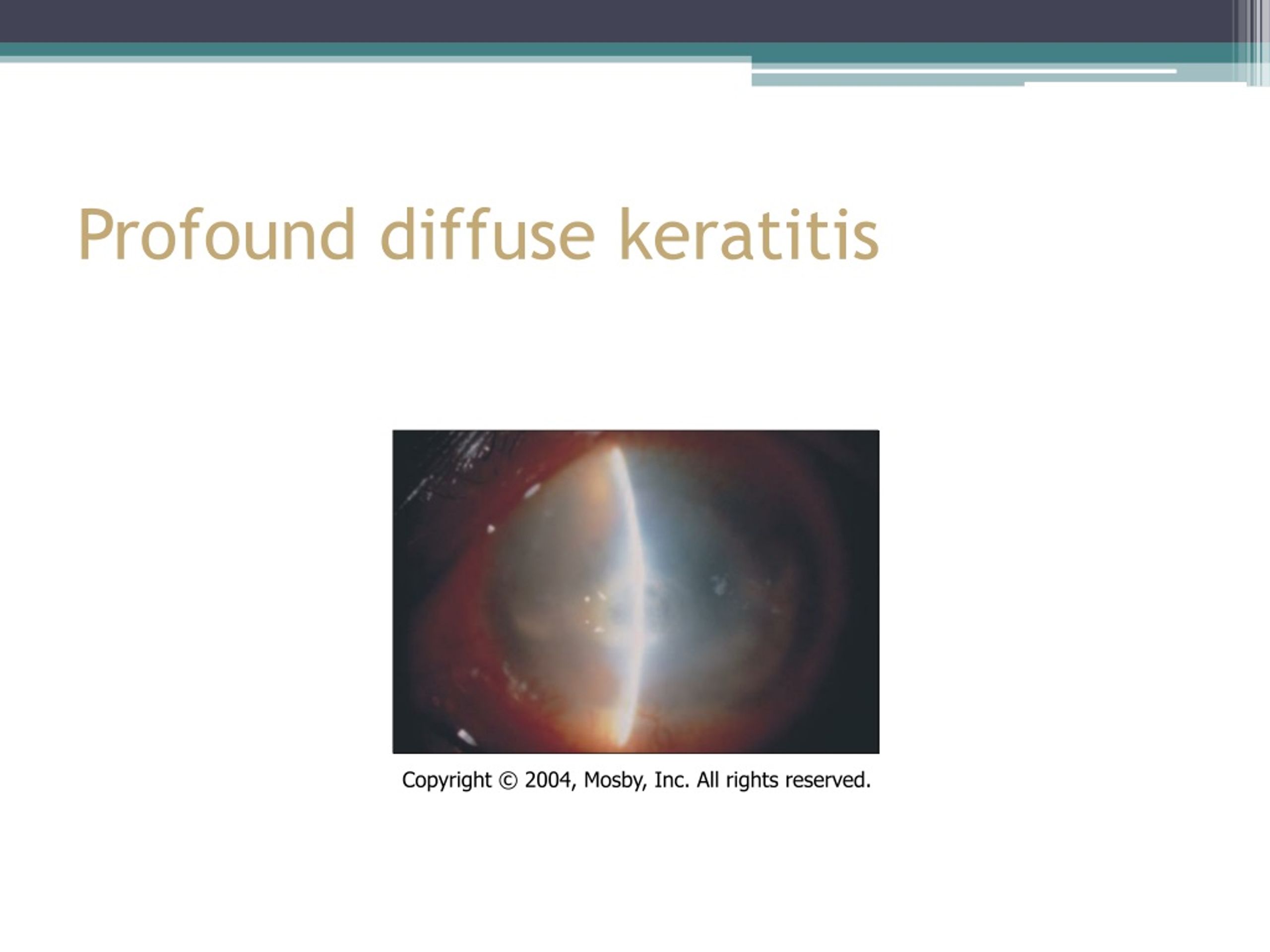 This is called saddle nose, which is classified into anterior, due to affection of the cartilaginous portion, and posterior, as an affection of the osseous . PPT - Keratitis PowerPoint Presentation, free download