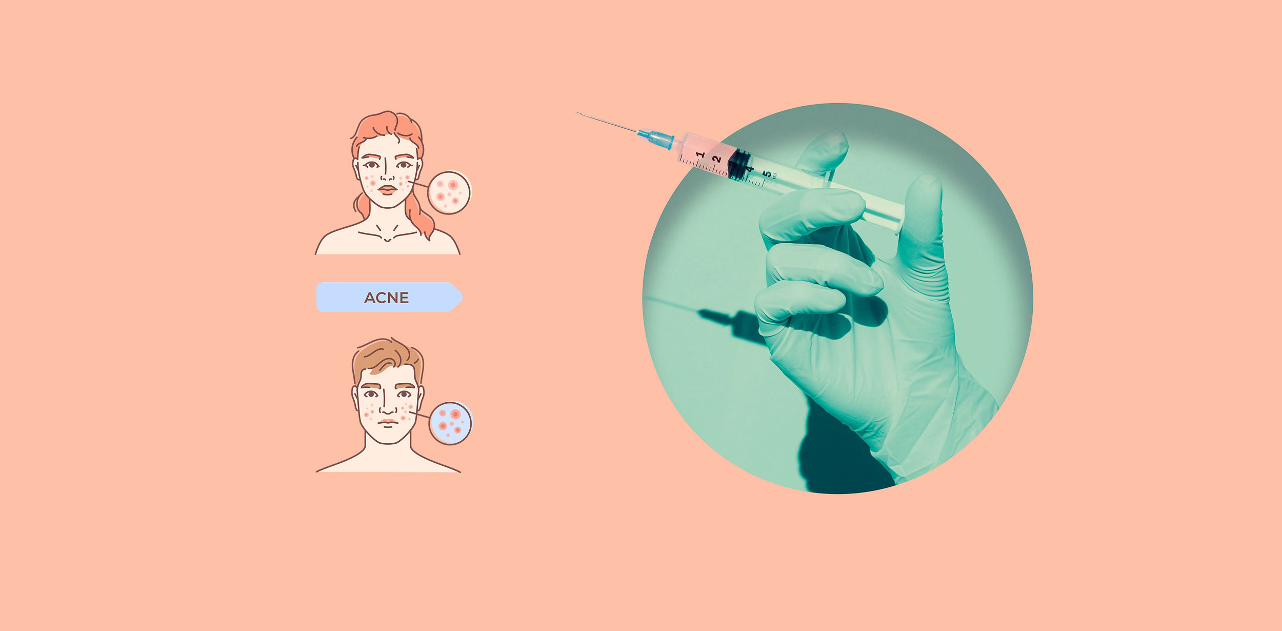 China's First Acne Vaccine Enters Clinical Trials: A Game-Changer? (2026)