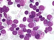 View Of Cells In Acute Lymphocytic Leukemia