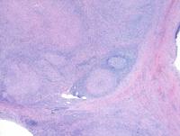 Necrotizing Granulomatous Lymphadenitis