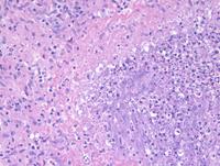 Necrotizing Granulomatous Lymphadenitis