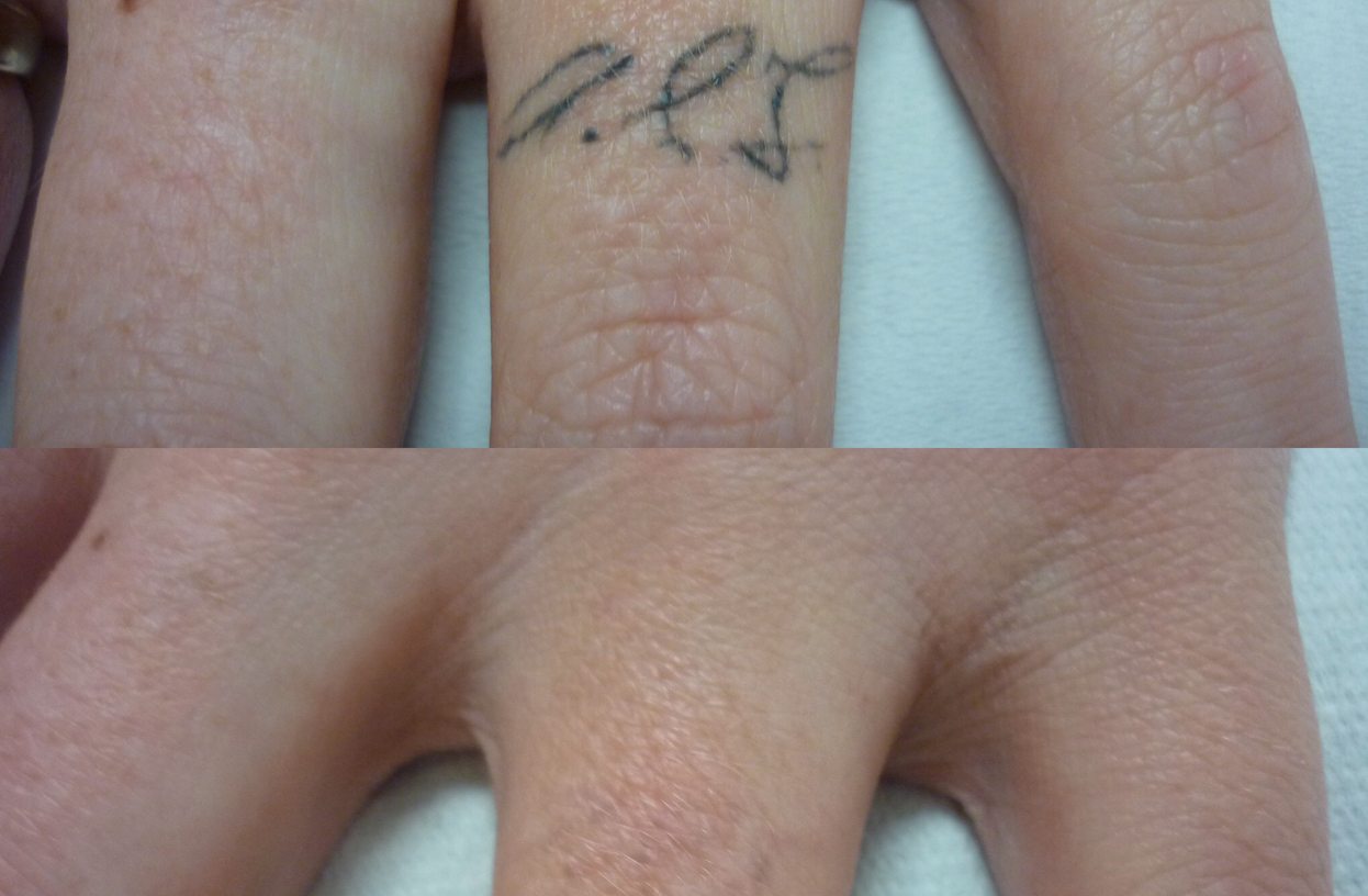 Non-laser vs. laser tattoo removal