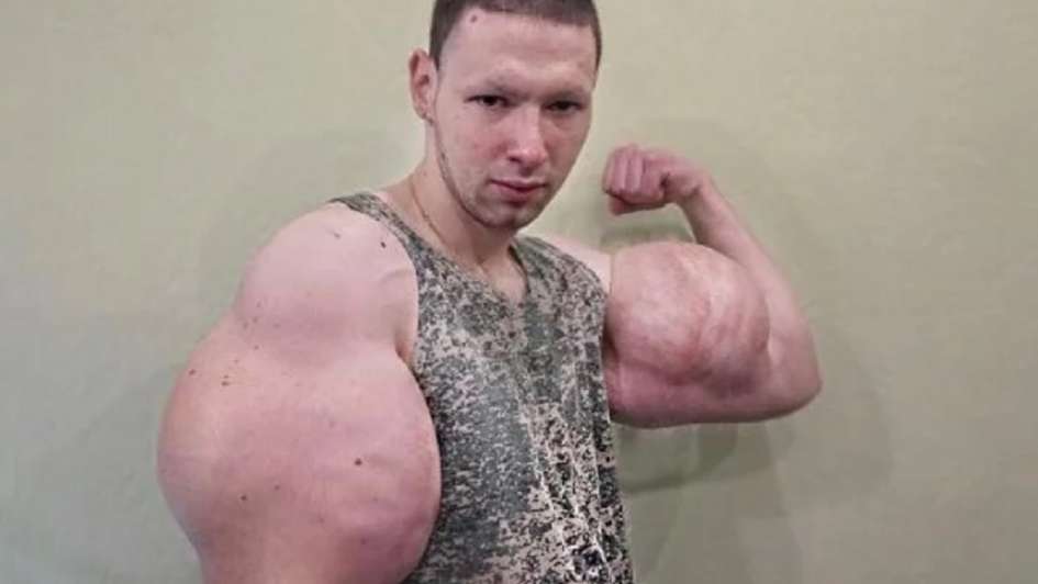 Kirill tereshin, conocido como el 'popeye ruso', ha vuelto a un ring de lucha de artes marciales mixtas (mma por sus siglas en ingles) y ha . ¡El 'Popeye Ruso' se quita el aceite inyectado en sus bíceps!