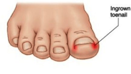 The toes and feet bear the weight of the body every day. Ingrown Toenails What How Why Cornerstone Foot Ankle