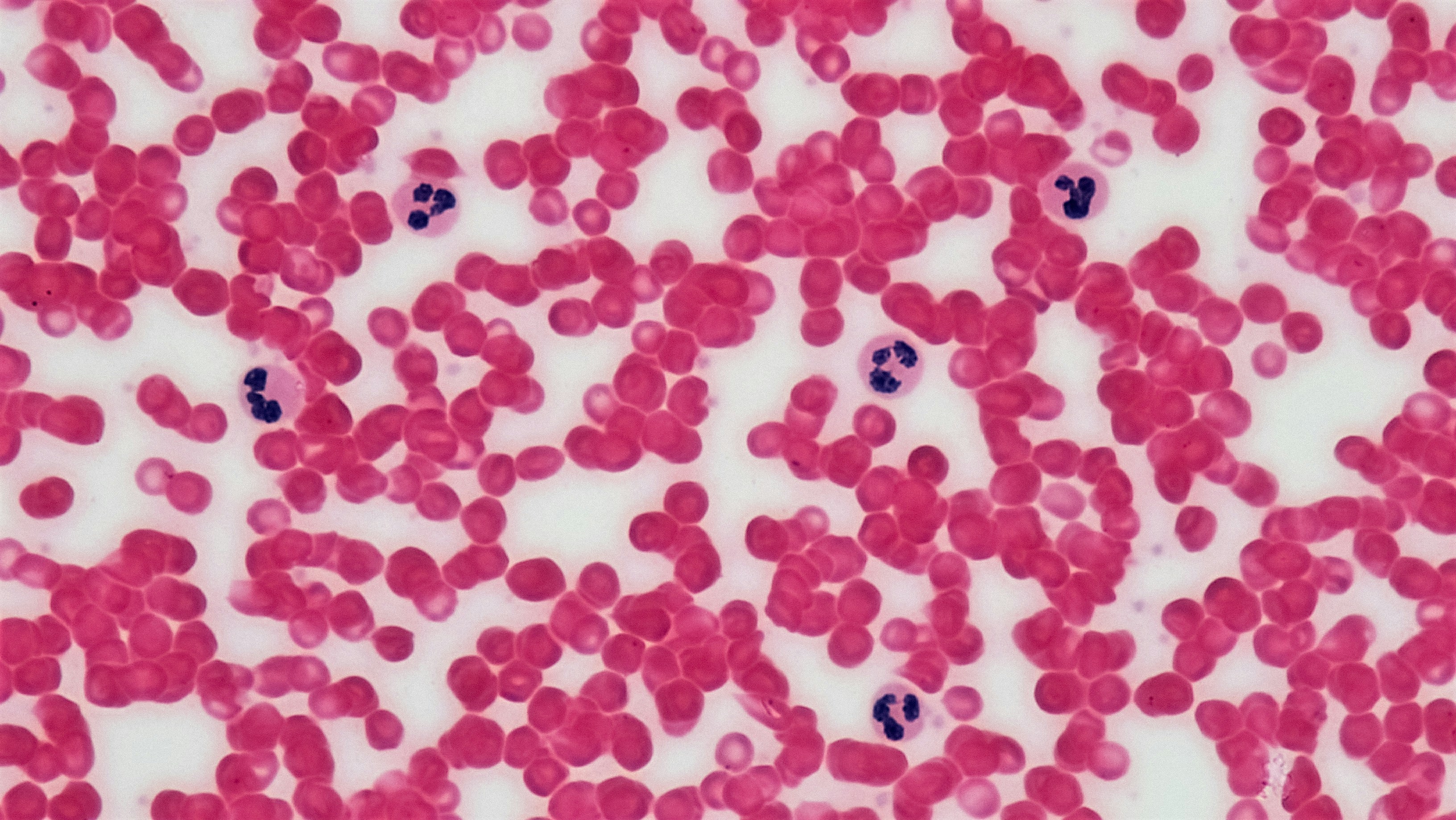 Hematologi Klinik 2