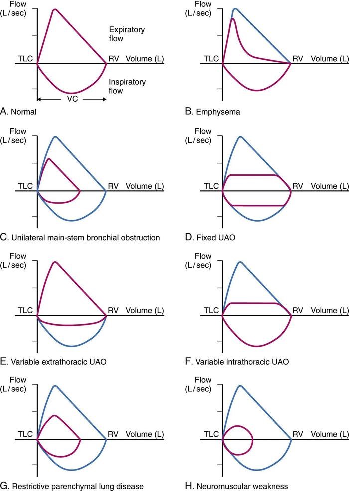 Inspiratory flow loop flattening at delores eldridge blog