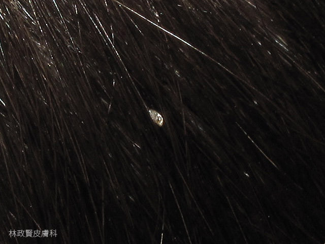 真 假頭蝨 傻傻分不清 高雄皮膚專科林政賢醫師