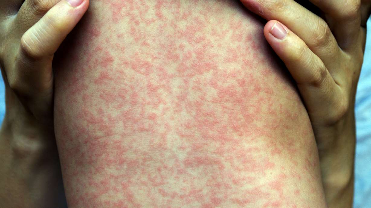 Measles Outbreak at Utah Wrestling Tournament: Vaccination Urgency & Spread Warning (2026)