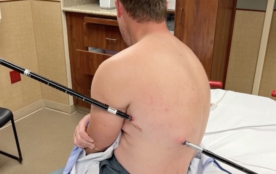 Surviving a Trekking Pole Impalement: Man's Incredible Journey Down Montana's Tallest Mountain (2026)