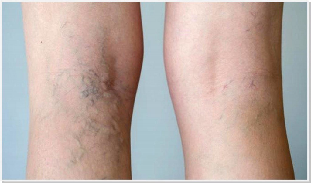 Com varizes nã9 faz tatuagem Tatuagem 9 Curiosidades Achoou Delivery De Farmacias E Drogarias