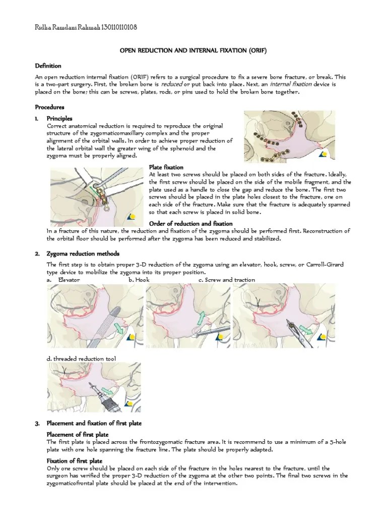 Open Reduction And Internal Fixation | PDF | Screw | Surgery