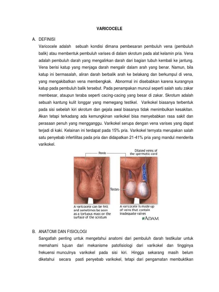Varicocele | PDF