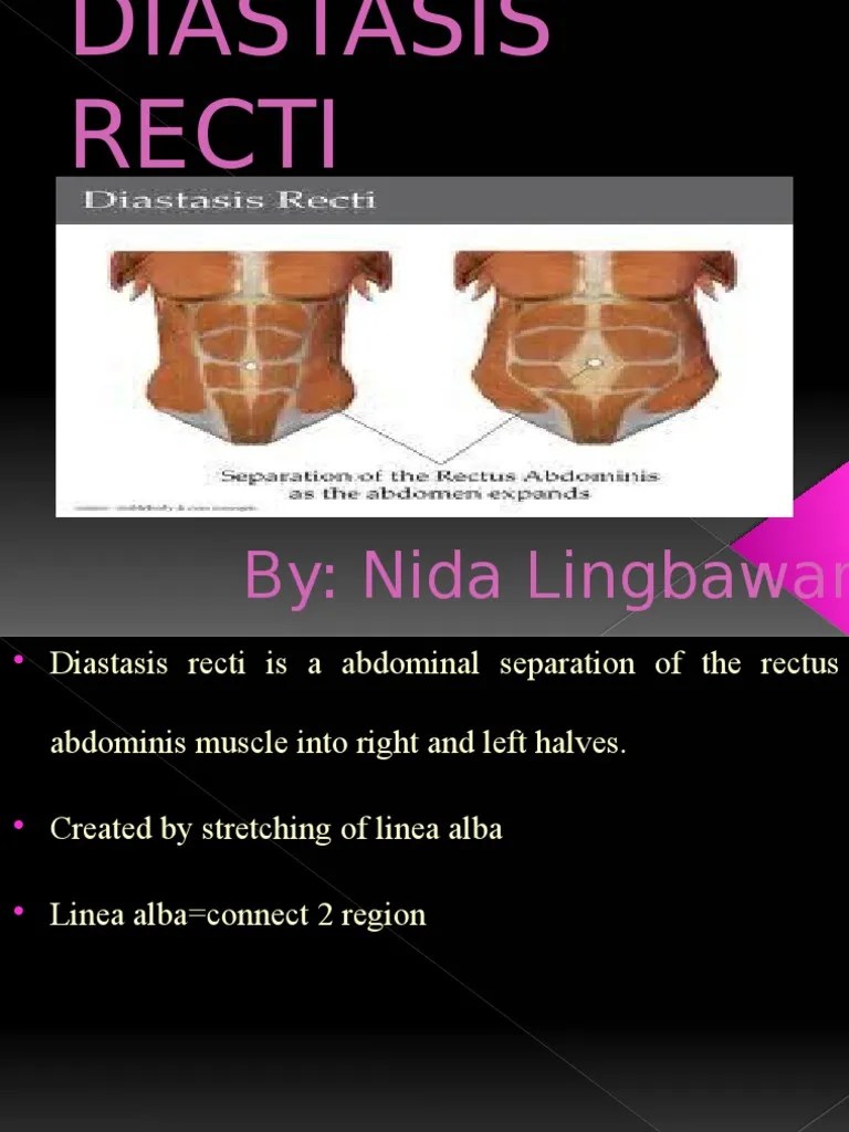 Diastasis Recti | Abdomen | Human Anatomy