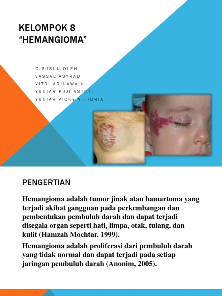 Hemangioma | PDF