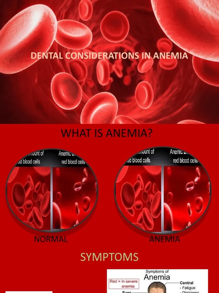 Dental Considerations In Anemia | PDF | Anemia | Hematology