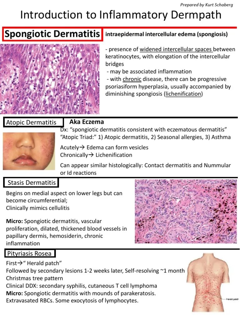 Spongiotic Dermatitis: Aka Eczema | PDF | Dermatitis | Epidermis