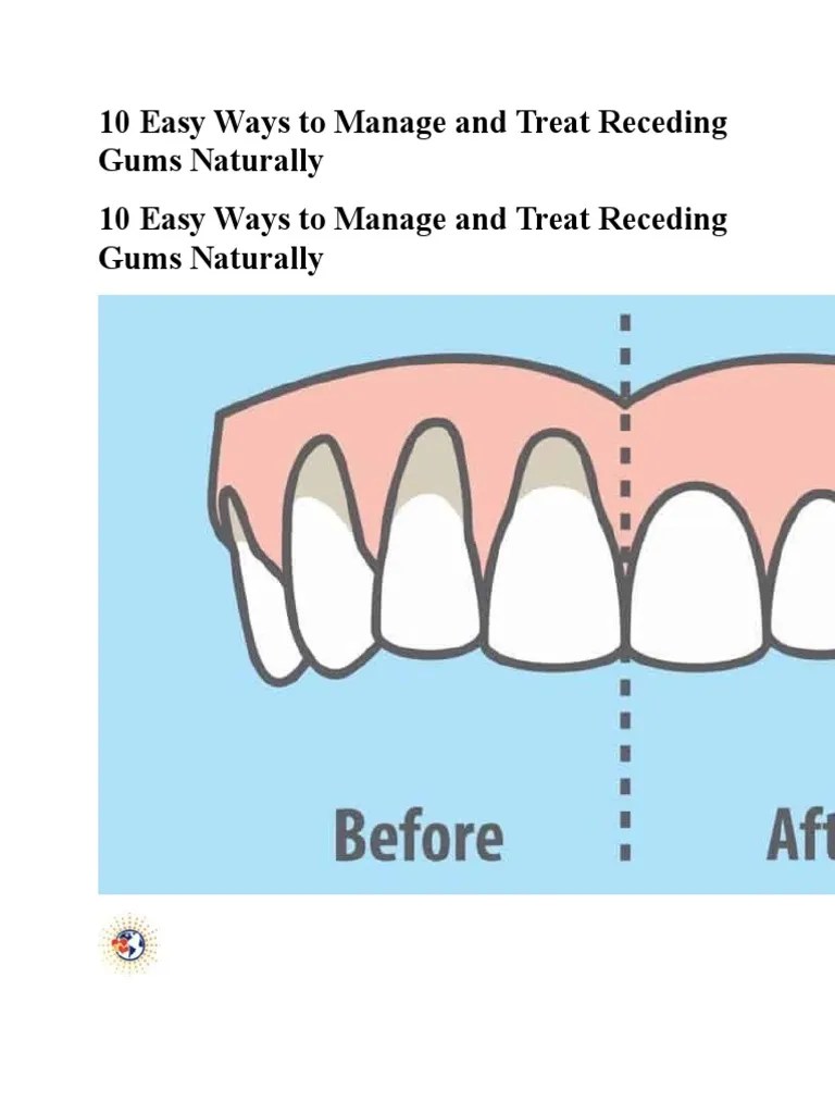 10 Easy Ways To Manage And Treat Receding Gums Naturally | PDF | Oral Hygiene | Periodontology
