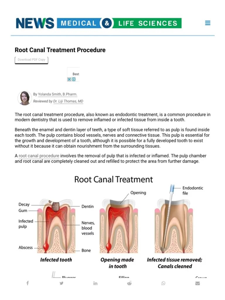 Root Canal Treatment Procedure | PDF | Health Sciences | Medical Specialties