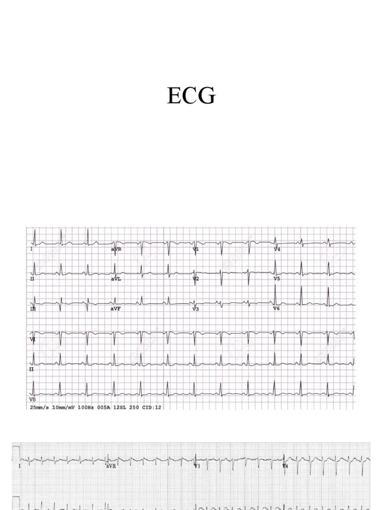 Ecg Interpretation For Internship | PDF