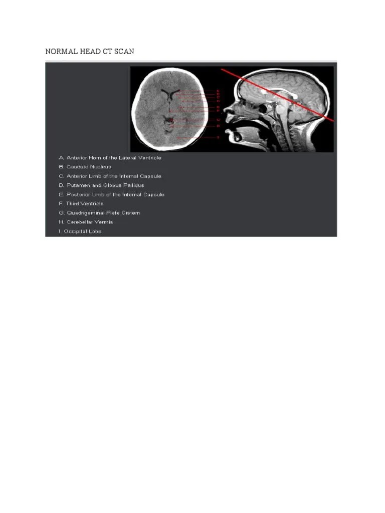 Normal Head CT Scan | PDF