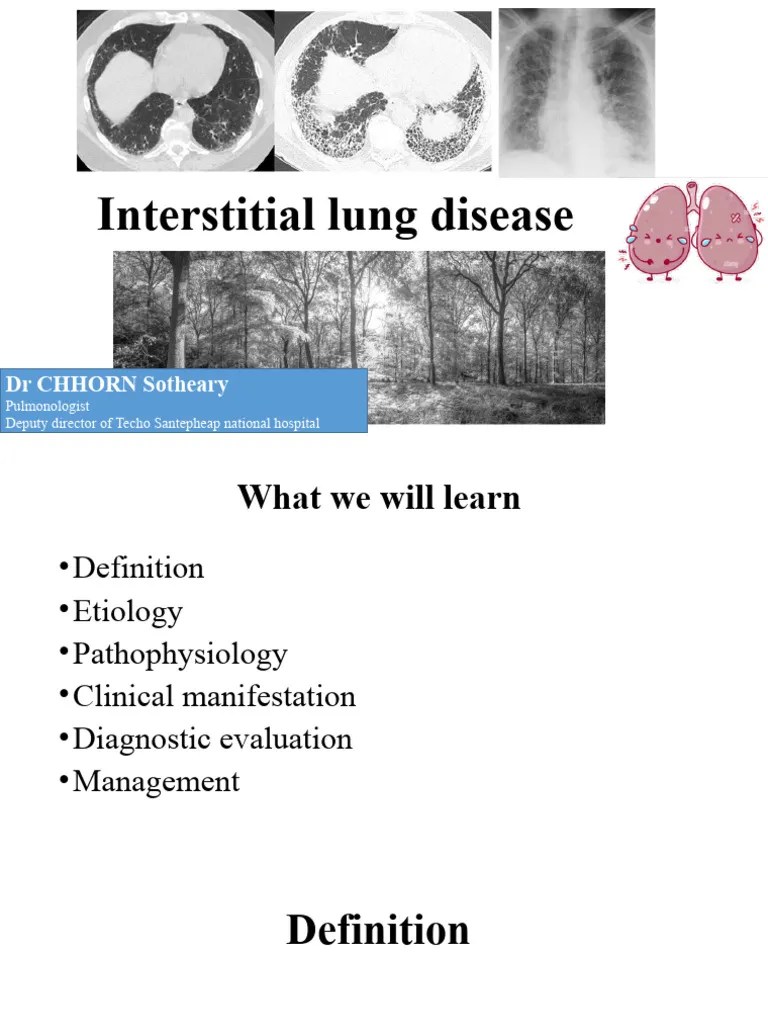 Interstitial Lung Disease | PDF