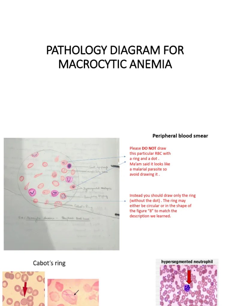 Pathology Diagram For Macrocytic Anemia | PDF