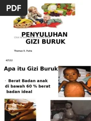 Lembar Balik Gizi Buruk | PDF