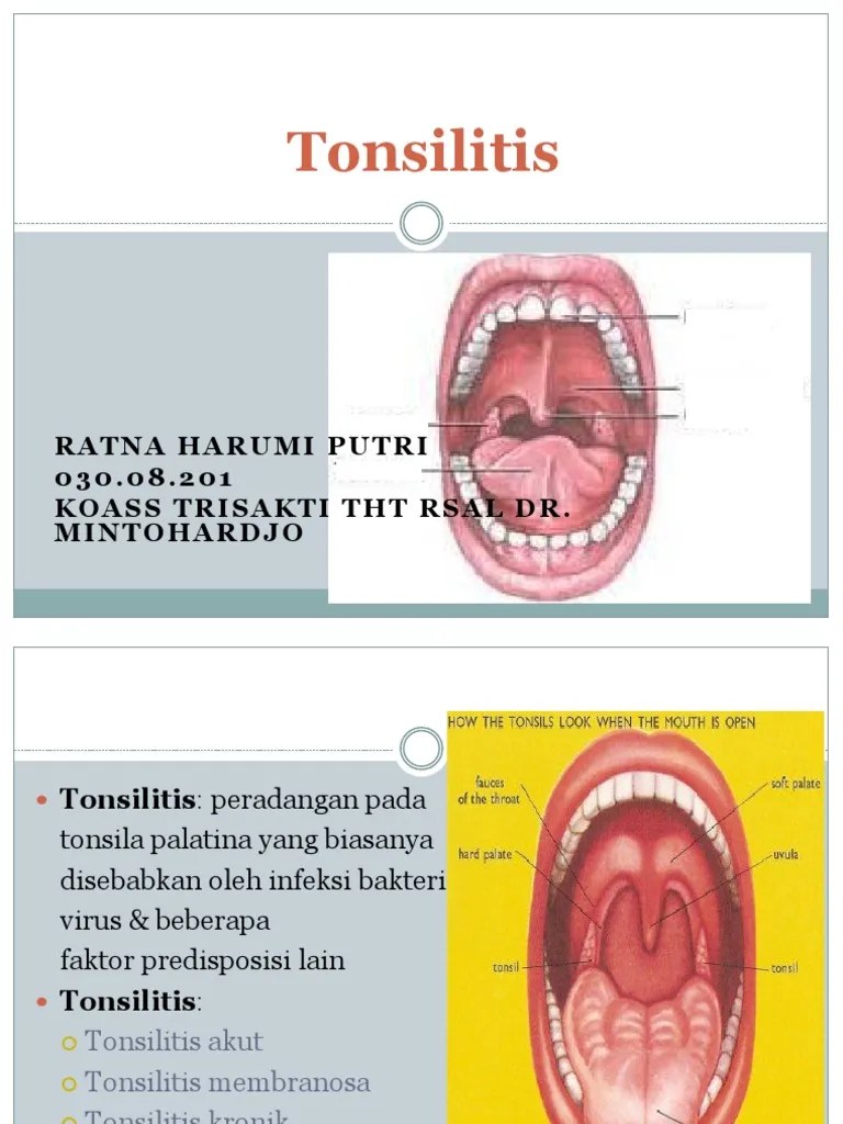 Tonsilitis | PDF