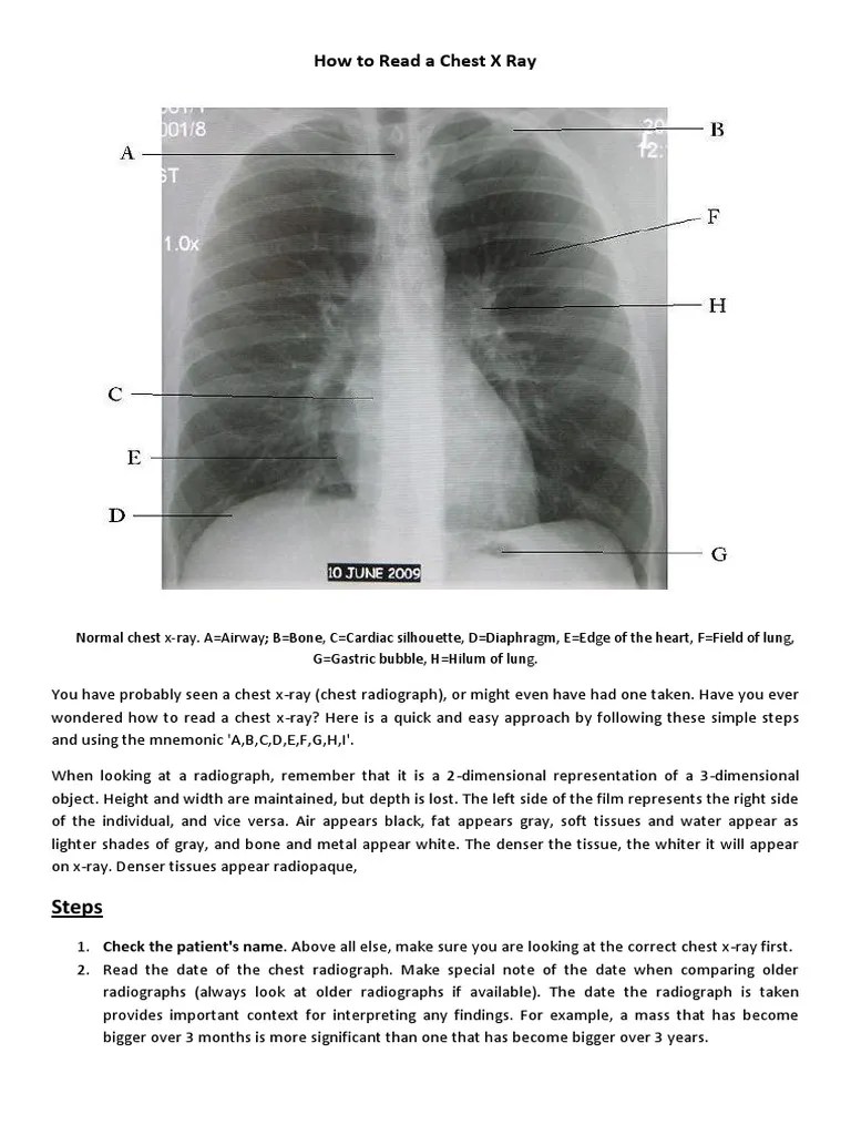 How To Read A Chest X Ray | PDF | Lung | Anatomy