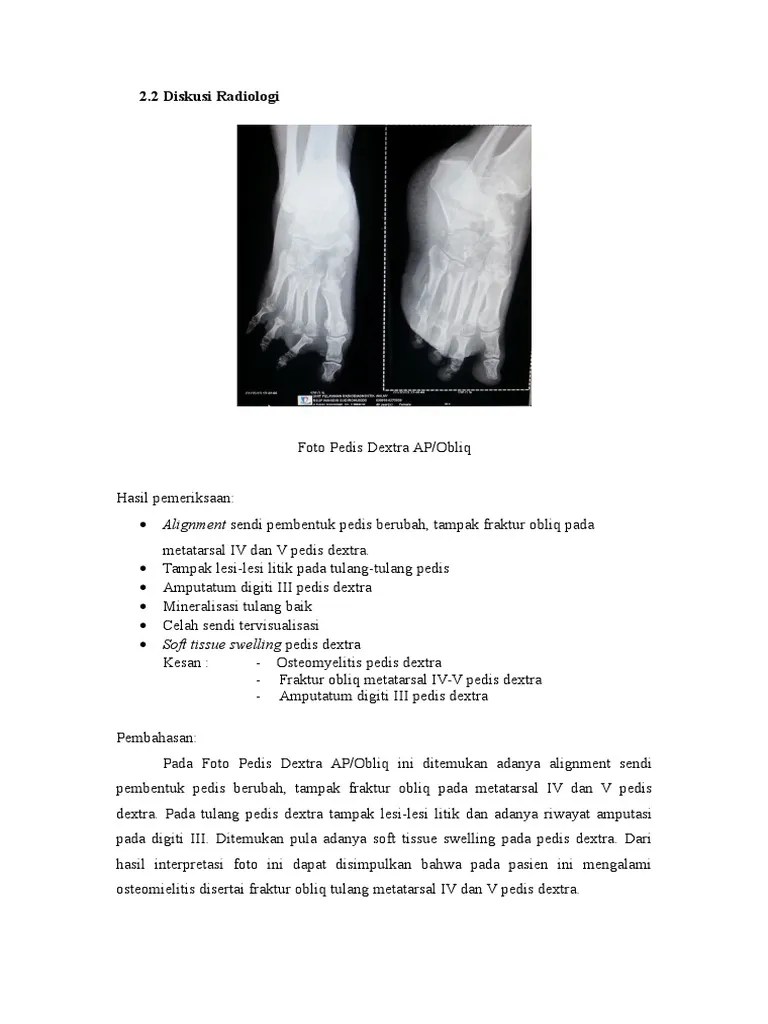 Osteomyelitis | PDF