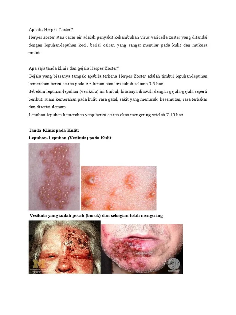 Apa Itu Herpes Zoster | PDF